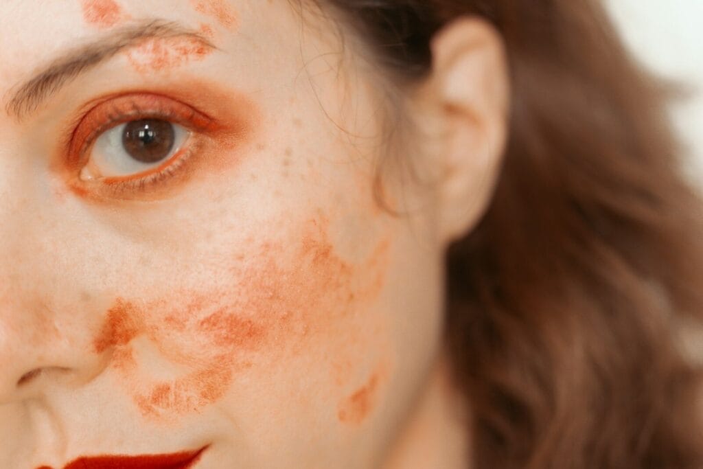 melasma