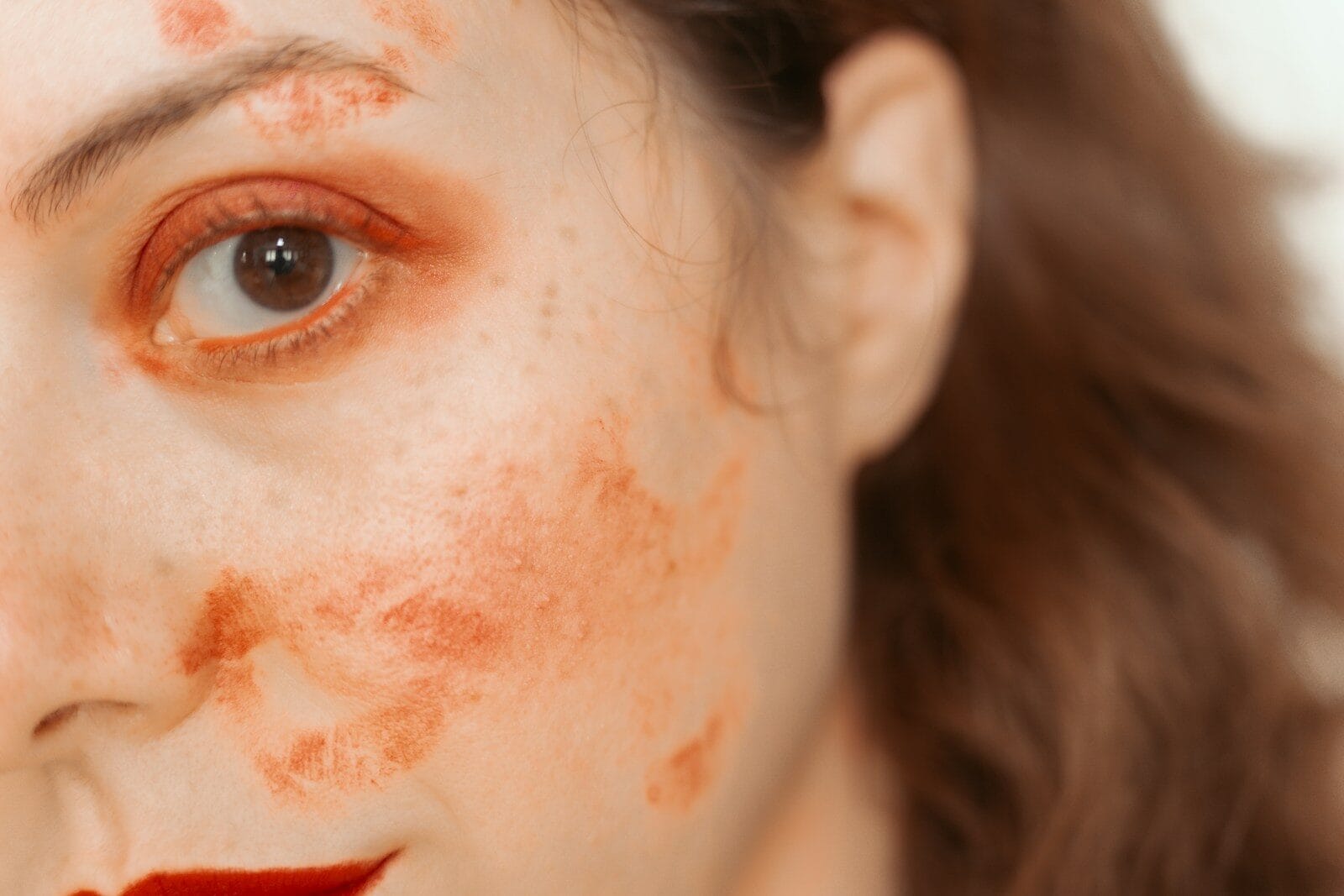 melasma
